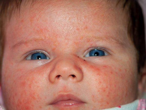 Аллергия на тыкву:  популярные вопросы и ответы на них