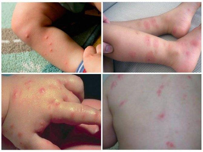 Аллергия на смородину у ребенка фото