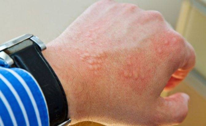 Аллергия на дыню симптомы у взрослых