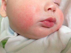 Может ли быть аллергия на тыквенные семечки: симптомы у взрослых и детей