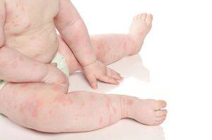 Аллергия на тыкву у взрослых и детей: симптомы + фото