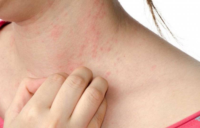 Аллергия от дыни симптомы