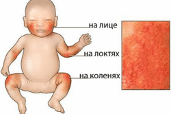 Аллергия на тыкву: причины, лечение