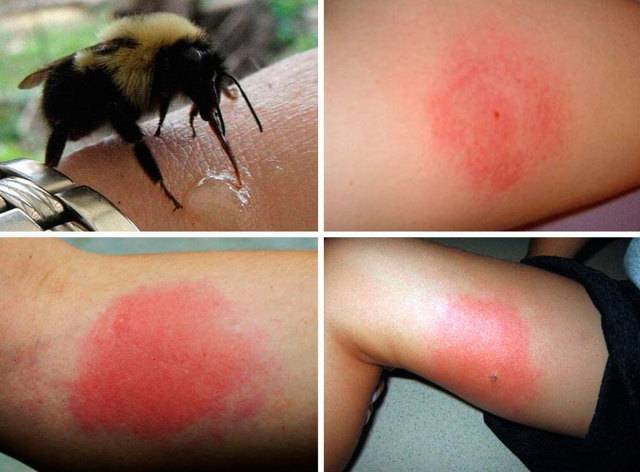 Ужалила пчела что делать опухла рука. укус пчелы или осы опухоль и покраснение что делать. укус женщины в положении.