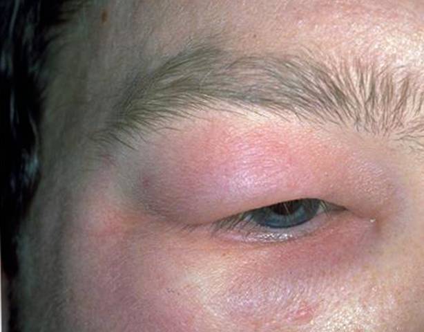 Аллергия на дыню: симптомы, причины, лечение у взрослых, у детей.