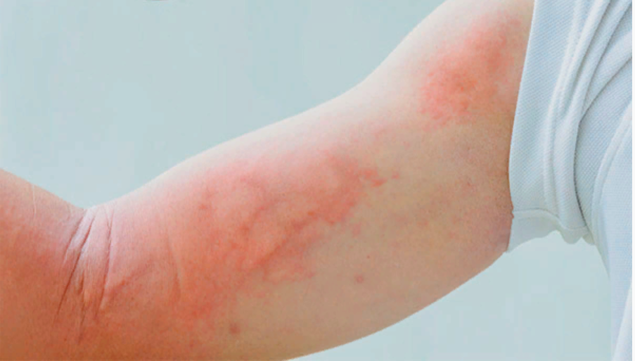 Аллергия на авокадо: причины, симптомы, диагностика, лечение